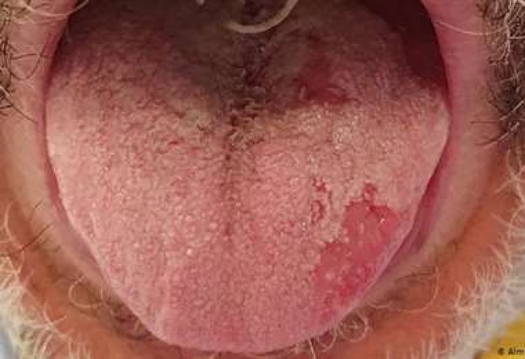 Lengua Covid y otros síntomas del coronavirus en la piel