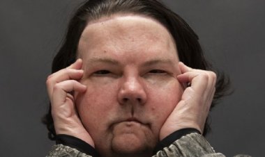 Realizan con éxito en EEUU el primer trasplante simultáneo de cara y manos