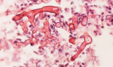 El estado indio de Jammu y Cachemira declara que el 'hongo negro' poscovid es una epidemia