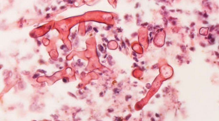 El estado indio de Jammu y Cachemira declara que el 'hongo negro' poscovid es una epidemia