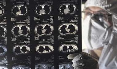 Alertan de casos de flurona y posible muerte; el Sedes aguarda informe