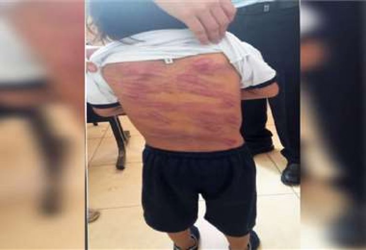 Profesores de un colegio descubren que un niño de 4 años con síndrome de Down fue flagelado por su padre