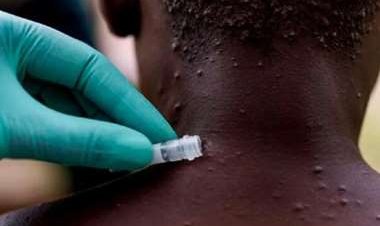 Tres casos en Italia de la viruela del mono en humanos