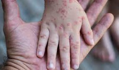 Tarija declara alerta epidemiológica por viruela del mono y Salud refuerza acciones ante posibles casos