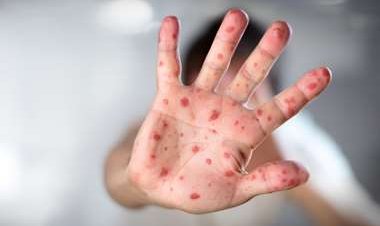 Confirman primer caso sospechoso de la viruela del mono en Santa Cruz