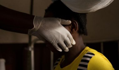 Viruela del mono: esto es lo que debes saber para evitar su contagio