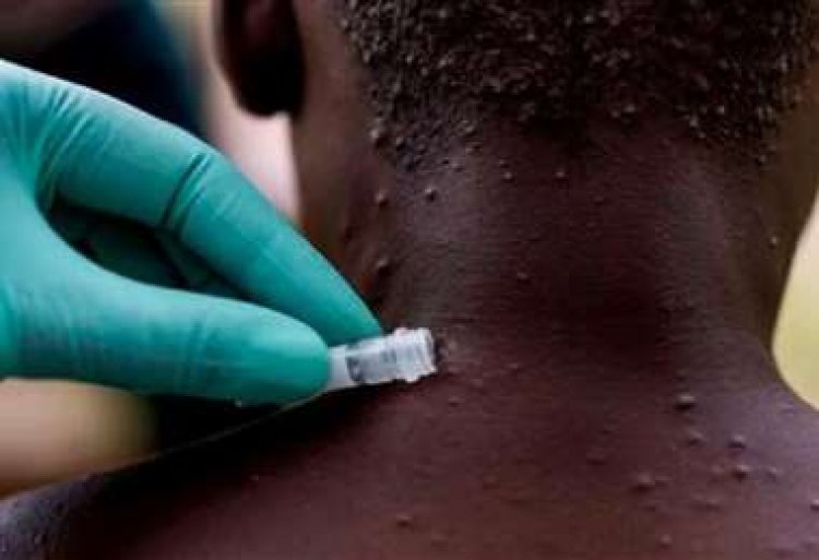 Tres casos en Italia de la viruela del mono en humanos