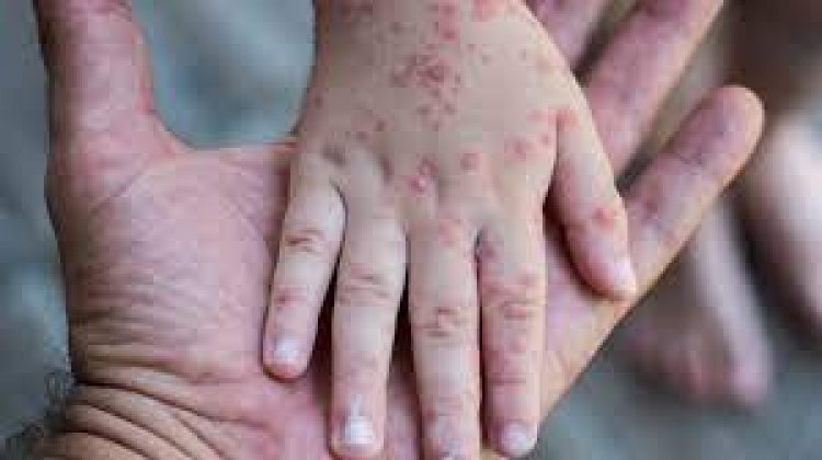 Tarija declara alerta epidemiológica por viruela del mono y Salud refuerza acciones ante posibles casos