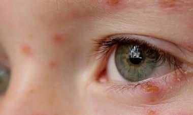 OMS: transmisión de la viruela del mono ya es comunitaria en varias regiones