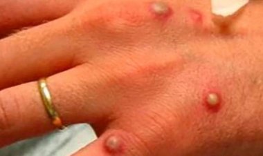 Bolivia reporta el primer caso de viruela del mono; seis datos que debe conocer