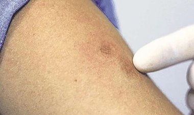 Hay seis casos de viruela del mono y habilitan 28 camas de aislamiento