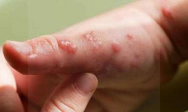 Expertos británicos presentan ensayo de tratamiento para la viruela del mono