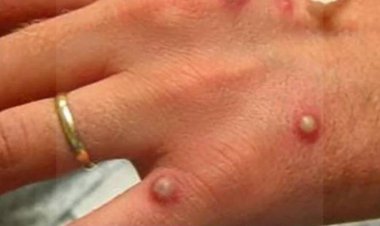 Bolivia registra 49 pacientes activos con viruela del mono, entre ellos el primer positivo en una mujer