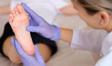 Primer caso femenino de viruela símica corresponde a una niña de 11 años de Cochabamba