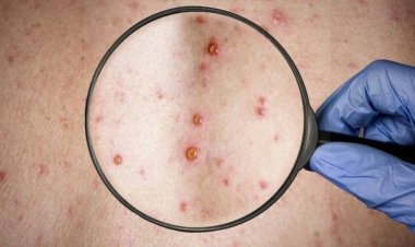 Chuquisaca confirma su primer caso de viruela del mono