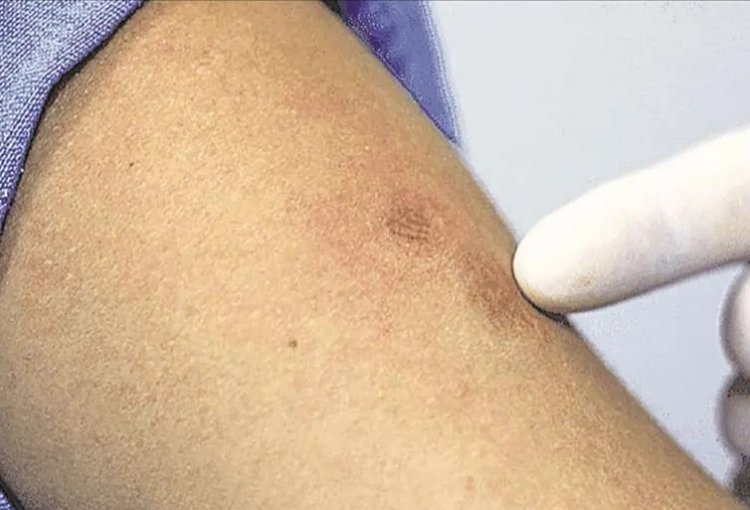Hay seis casos de viruela del mono y habilitan 28 camas de aislamiento
