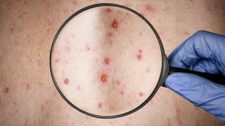 Chuquisaca confirma su primer caso de viruela del mono