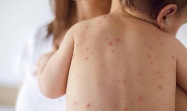 El Ministerio de Salud declaró Alerta Epidemiológica Nacional por Sarampión.