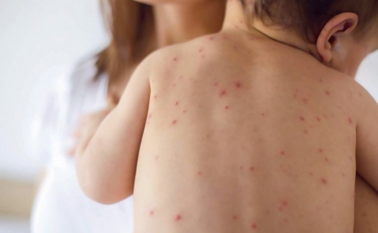 El Ministerio de Salud declaró Alerta Epidemiológica Nacional por Sarampión.