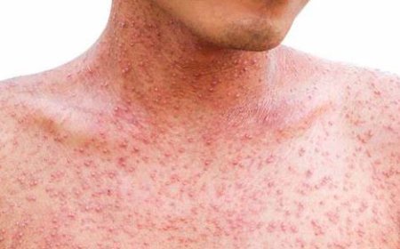 Nuevo caso de sarampión importado en Santa Cruz: Salud intensifica vacunación en todo el país