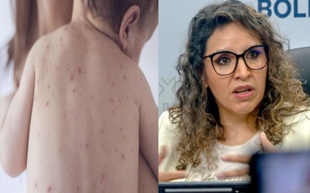 Confirman 20 casos de sarampión en Santa Cruz y el Ministerio de Salud refuerza acciones para contener el brote