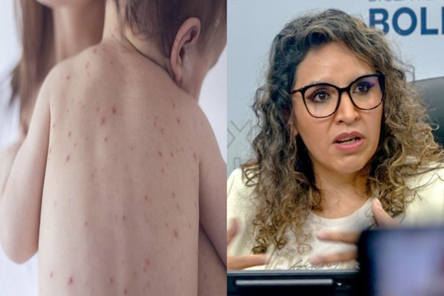 Confirman 20 casos de sarampión en Santa Cruz y el Ministerio de Salud refuerza acciones para contener el brote