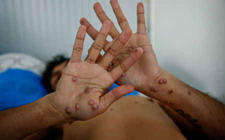 Sube a ocho la cifra de casos de viruela del mono en Santa Cruz