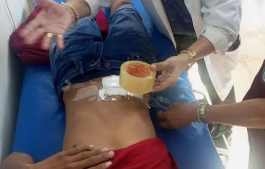 Médicos de Riberalta usaron ‘yúrex’ por falta de cinta médica; Alcaldía niega desabastecimiento.